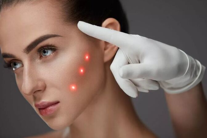 Ang Ripurevenation sa Laser sa panit