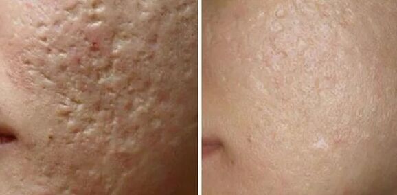 Laser nga paggiling sa mga scars